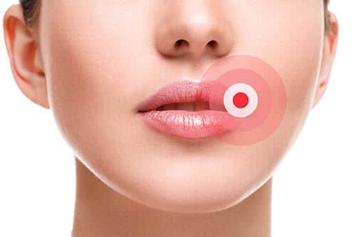 Was tun gegen Lippenherpes